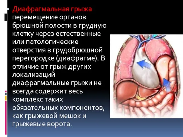 Диафрагмальная грыжа перемещение органов брюшной полости в грудную клетку через естественные