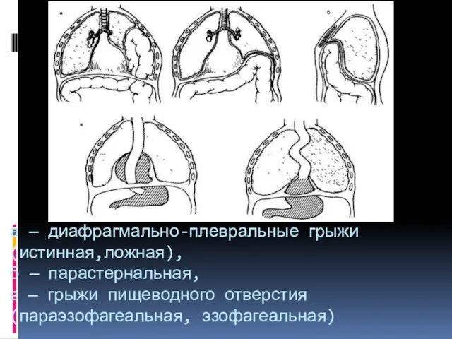 а — диафрагмально-плевральные грыжи (истинная,ложная), б — парастернальная, в — грыжи пищеводного отверстия (параэзофагеальная, эзофагеальная)