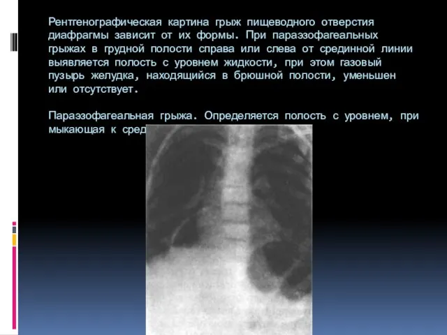 Рентгенографическая картина грыж пищеводного отверстия диафрагмы зависит от их формы. При