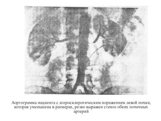 Аортограмма пациента с атеросклеротическим поражением левой почки, которая уменьшена в размерах,