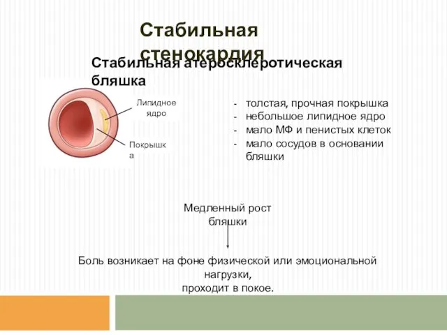 Стабильная атеросклеротическая бляшка Покрышка Липидное ядро толстая, прочная покрышка небольшое липидное