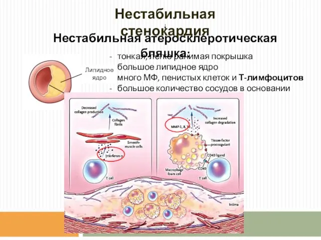 тонкая, легко ранимая покрышка большое липидное ядро много МФ, пенистых клеток