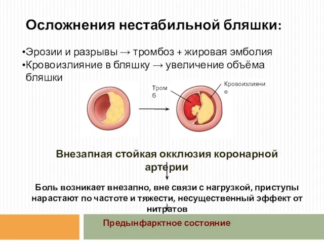 Осложнения нестабильной бляшки: Эрозии и разрывы → тромбоз + жировая эмболия