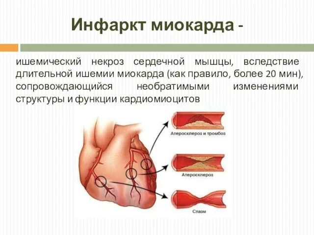 Инфаркт миокарда - ишемический некроз сердечной мышцы, вследствие длительной ишемии миокарда