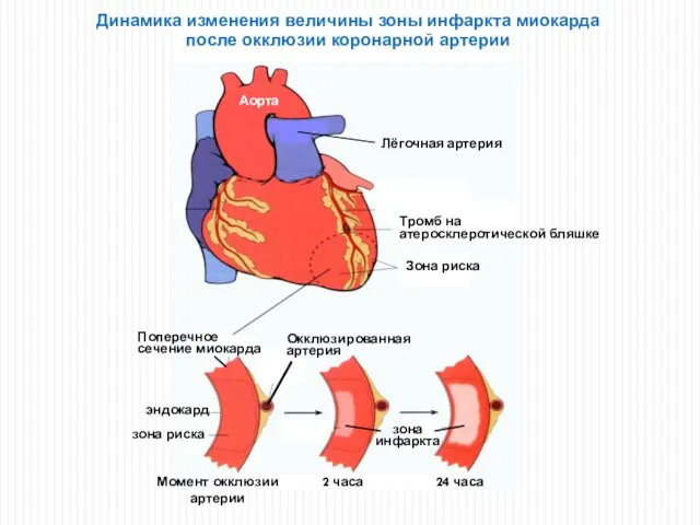 Динамика изменения величины зоны инфаркта миокарда после окклюзии коронарной артерии