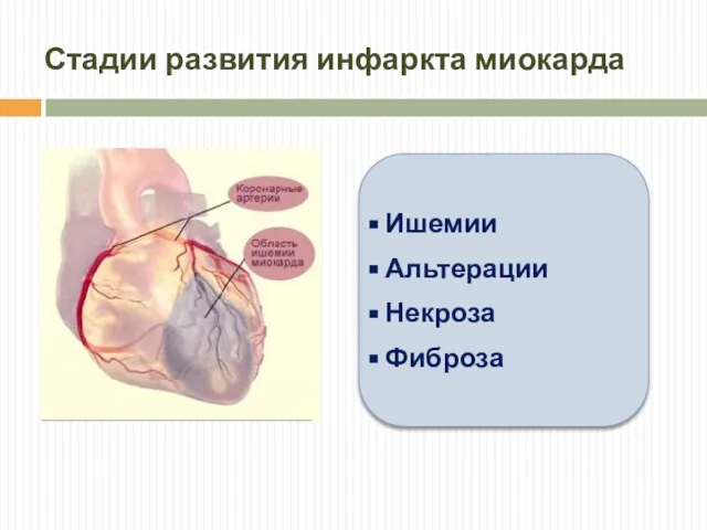 Стадии развития инфаркта миокарда Ишемии Альтерации Некроза Фиброза