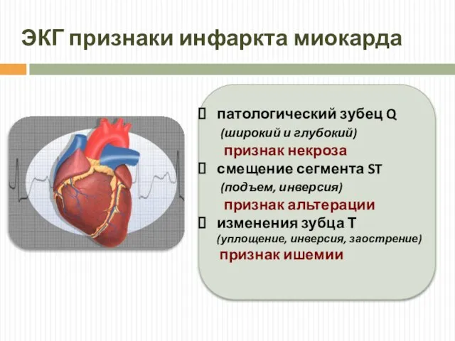 ЭКГ признаки инфаркта миокарда патологический зубец Q (широкий и глубокий) признак