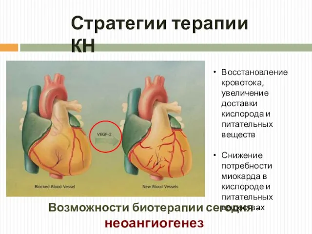 Возможности биотерапии сегодня - неоангиогенез Стратегии терапии КН Восстановление кровотока, увеличение