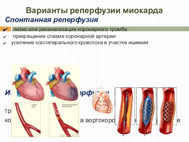 Варианты реперфузии миокарда Спонтанная реперфузия лизис или реканализация коронарного тромба прекращение