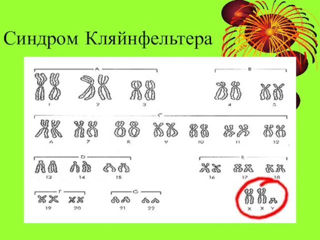 Синдром Кляйнфельтера