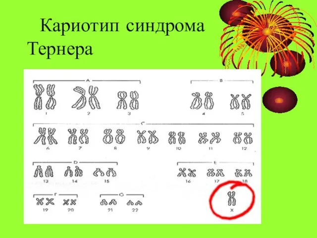 Кариотип синдрома Тернера