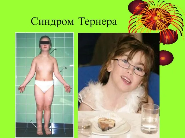 Синдром Тернера