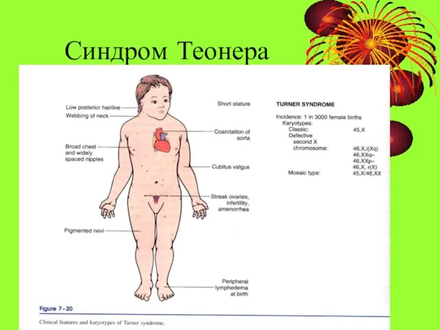 Синдром Теонера