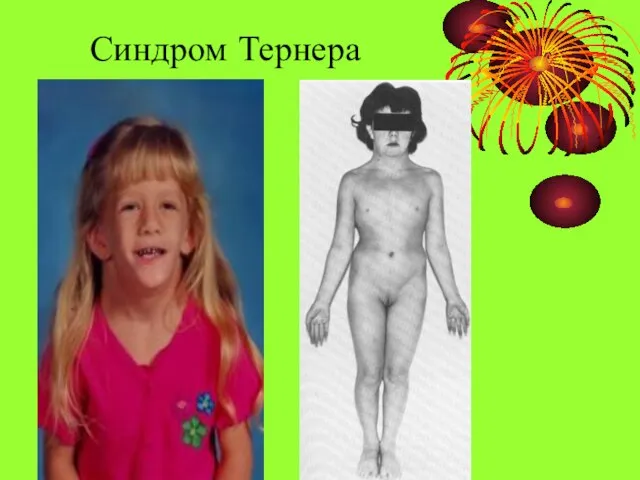 Синдром Тернера