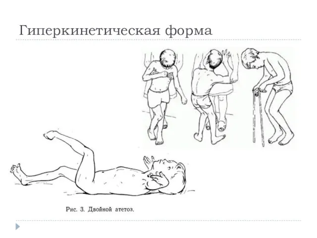 Гиперкинетическая форма