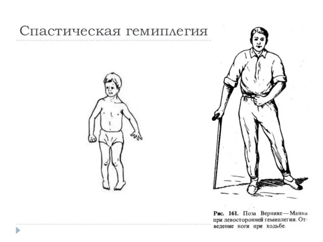 Спастическая гемиплегия