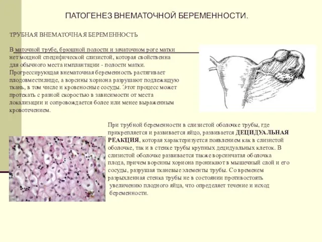 ТРУБНАЯ ВНЕМАТОЧНАЯ БЕРЕМЕННОСТЬ В маточной трубе, брюшной полости и зачаточном роге