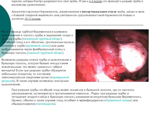 Если плодное яйцо развивается в истмическом отделе трубы, то имеет место