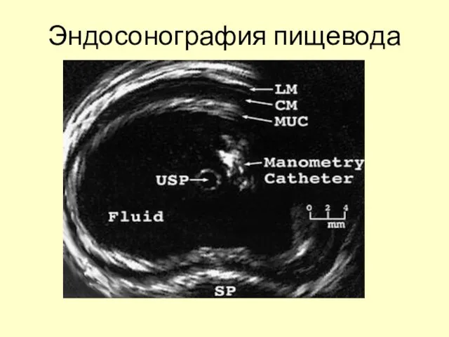 Эндосонография пищевода