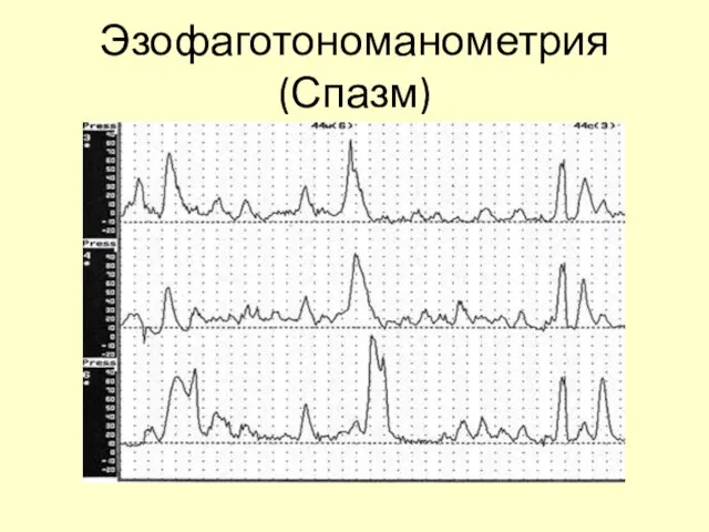 Эзофаготономанометрия (Спазм)