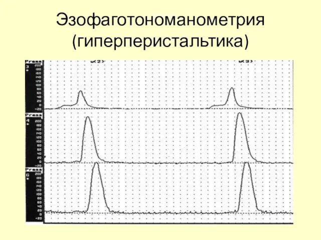 Спазм Эзофаготономанометрия (гиперперистальтика)