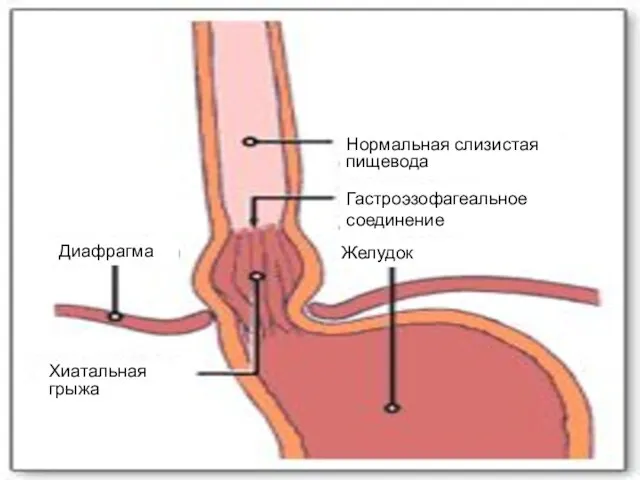 Нормальная слизистая пищевода Диафрагма Желудок Хиатальная грыжа Гастроэзофагеальное соединение