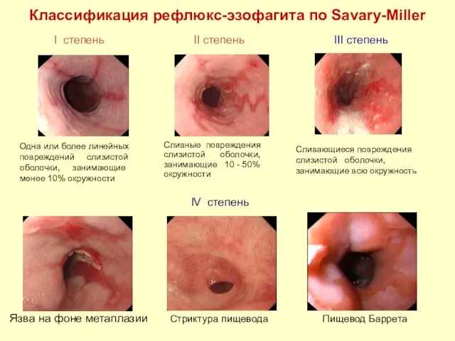 IV степень Язва на фоне метаплазии Стриктура пищевода Пищевод Баррета Классификация