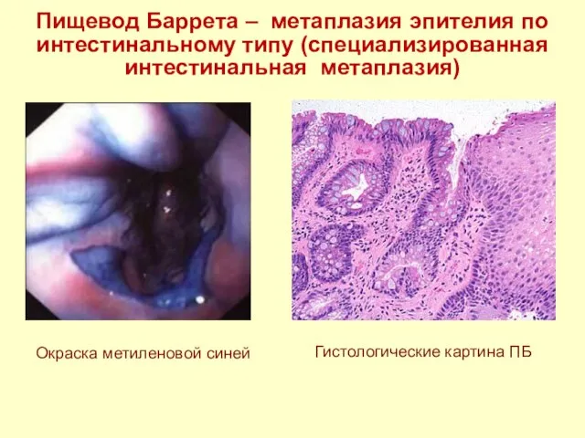 Пищевод Баррета – метаплазия эпителия по интестинальному типу (специализированная интестинальная метаплазия)
