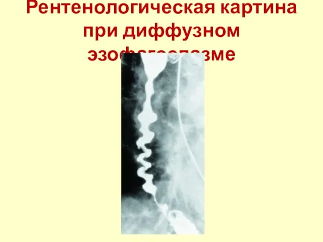 Рентенологическая картина при диффузном эзофагоспазме