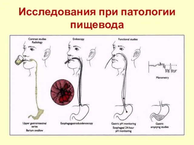 Исследования при патологии пищевода