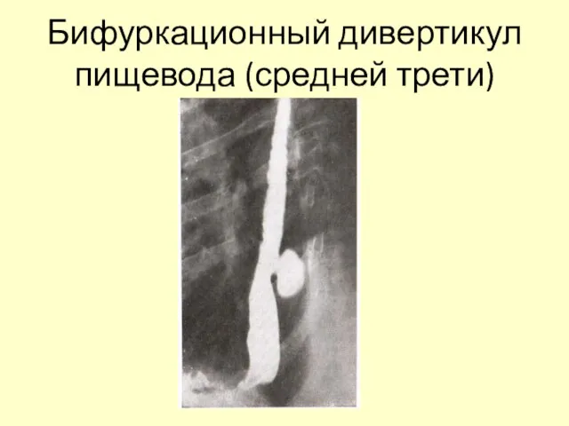 Бифуркационный дивертикул пищевода (средней трети)