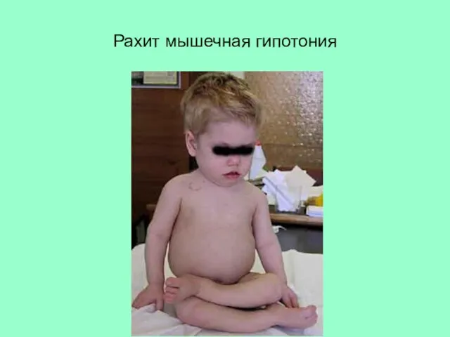 Рахит мышечная гипотония