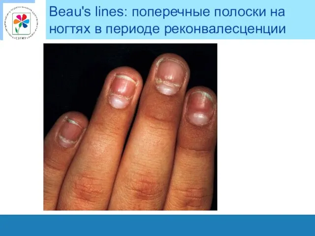 Beau's lines: поперечные полоски на ногтях в периоде реконвалесценции