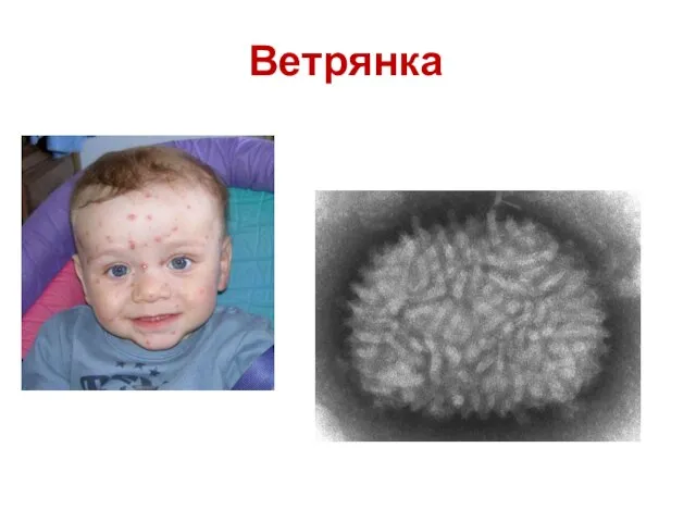 Ветрянка