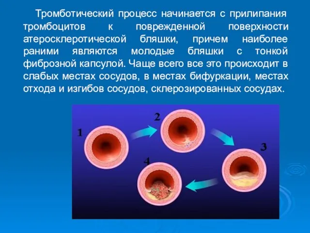 Тромботический процесс начинается с прилипания тромбоцитов к поврежденной поверхности атеросклеротической бляшки,