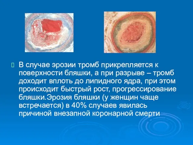 В случае эрозии тромб прикрепляется к поверхности бляшки, а при разрыве