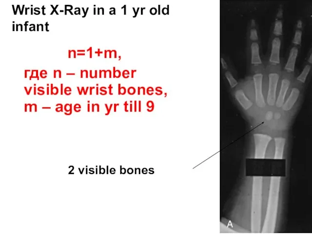 Wrist X-Ray in a 1 yr old infant 2 visible bones