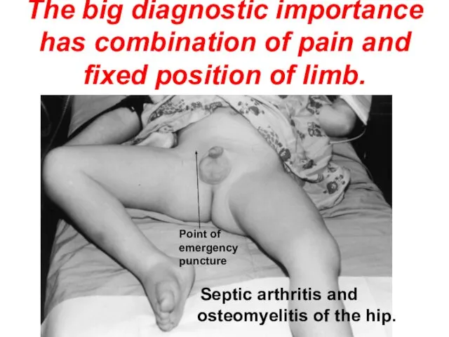 The big diagnostic importance has combination of pain and fixed position