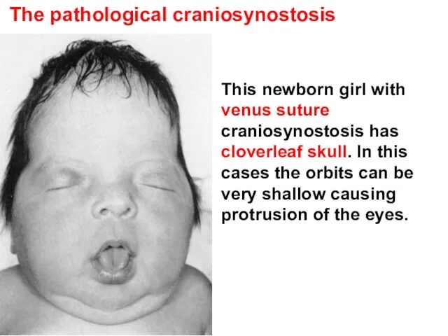 The pathological craniosynostosis This newborn girl with venus suture craniosynostosis has