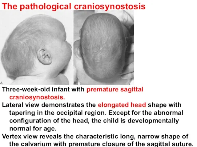 Three-week-old infant with premature sagittal craniosynostosis. Lateral view demonstrates the elongated