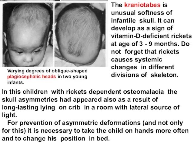 The kraniotabes is unusual softness of infantile skull. It can develop