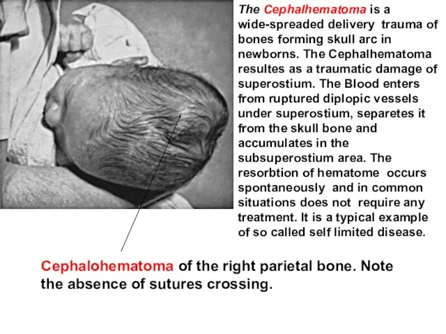 The Cephalhematoma is a wide-spreaded delivery trauma of bones forming skull