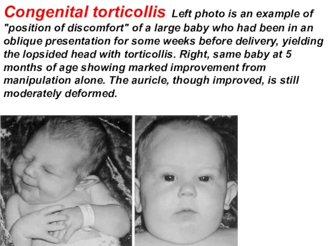 Congenital torticollis Left photo is an example of "position of discomfort"