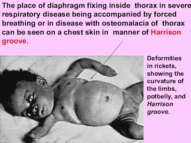 The place of diaphragm fixing inside thorax in severe respiratory disease