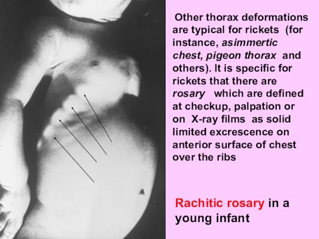 Other thorax deformations are typical for rickets (for instance, asimmertic chest,