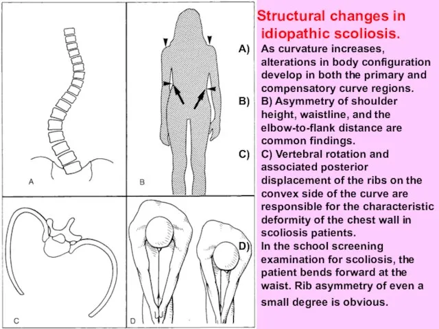Structural changes in idiopathic scoliosis. As curvature increases, alterations in body