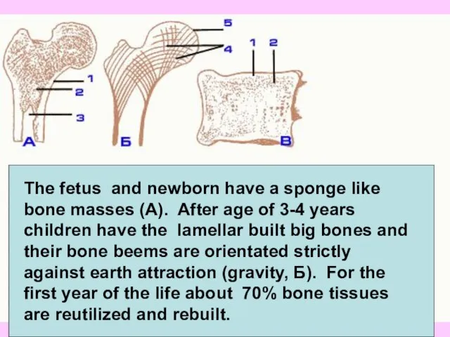 The fetus and newborn have a sponge like bone masses (A).