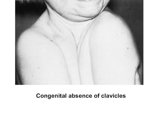 Congenital absence of clavicles