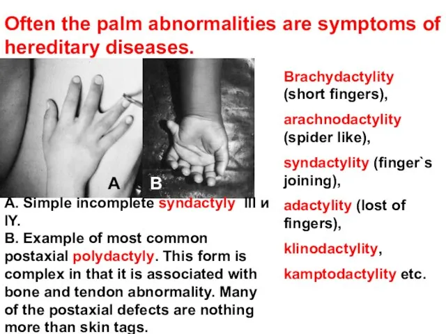 Often the palm abnormalities are symptoms of hereditary diseases. Brachydactylity (short