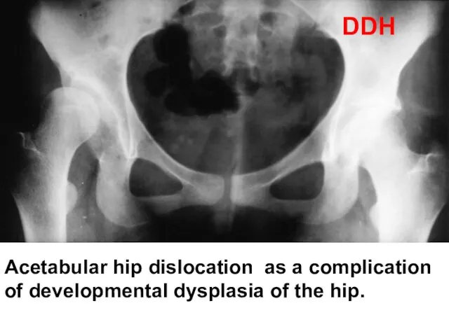 Acetabular hip dislocation as a complication of developmental dysplasia of the hip. DDH